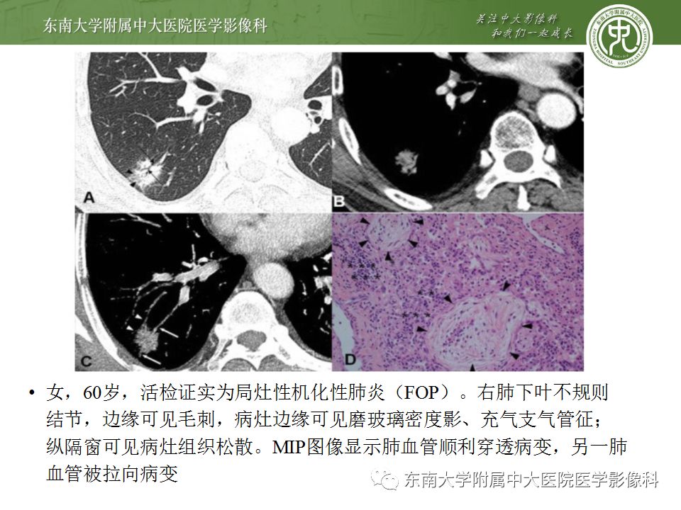 【PPT】局灶性机化性肺炎与周围型肺癌的鉴别-20
