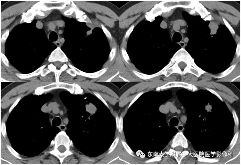 【PPT】局灶性机化性肺炎与周围型肺癌的鉴别-2