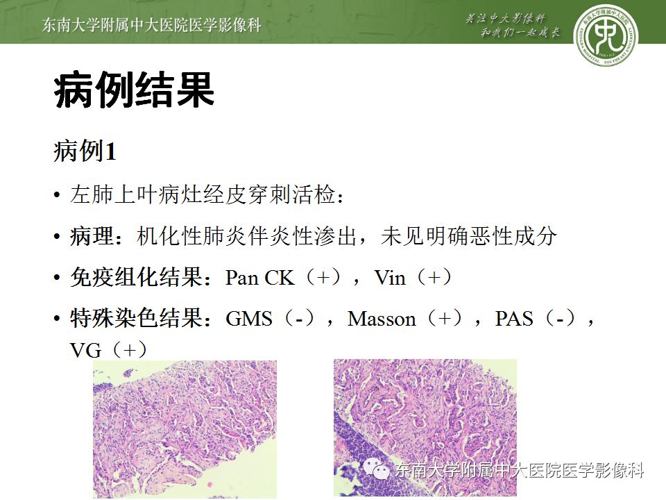 【PPT】局灶性机化性肺炎与周围型肺癌的鉴别-9