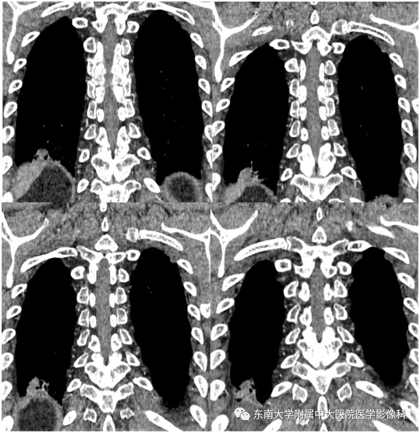 【PPT】局灶性机化性肺炎与周围型肺癌的鉴别-8