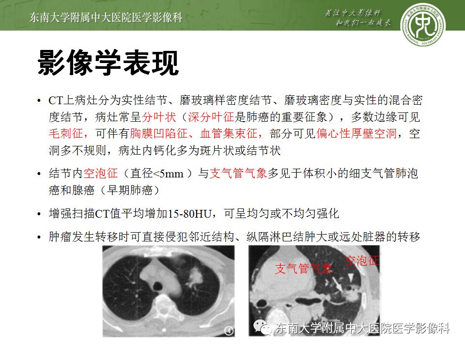 【PPT】局灶性机化性肺炎与周围型肺癌的鉴别-23