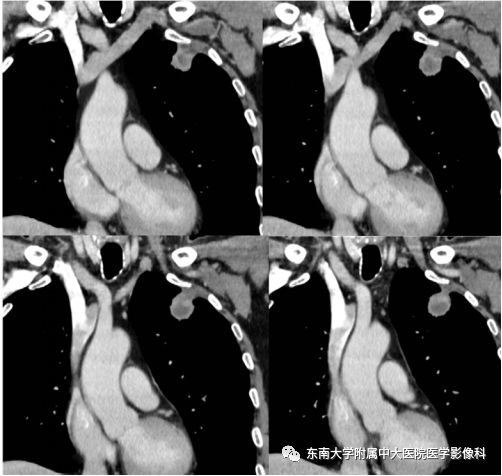 【PPT】局灶性机化性肺炎与周围型肺癌的鉴别-4