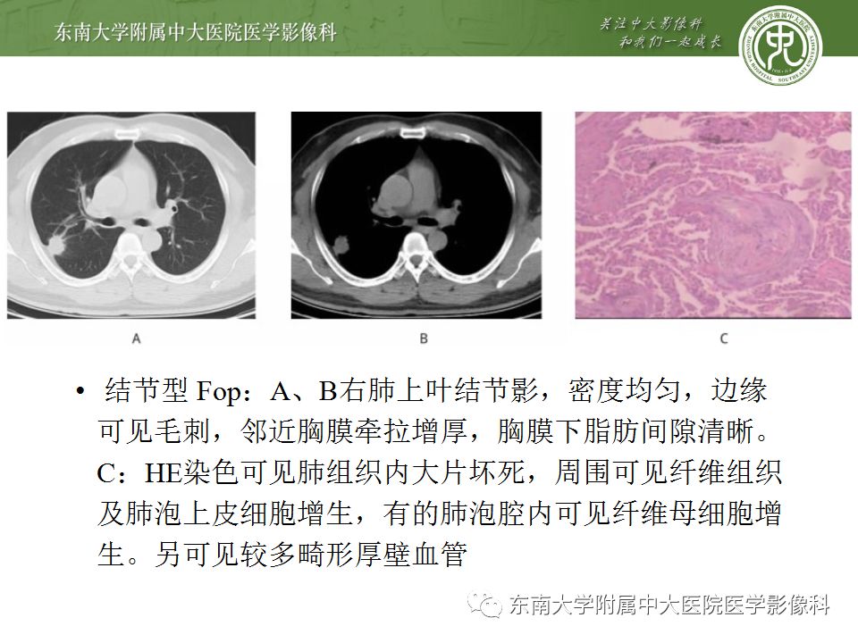 【PPT】局灶性机化性肺炎与周围型肺癌的鉴别-18