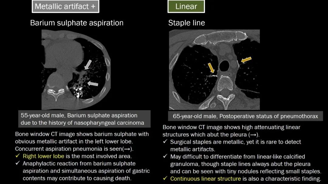 【PPT】肺部CT高密度病变诊断思路-25