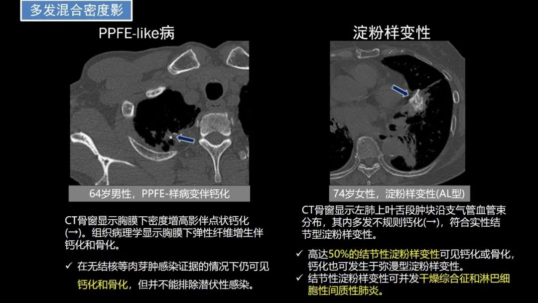【PPT】肺部CT高密度病变诊断思路-56