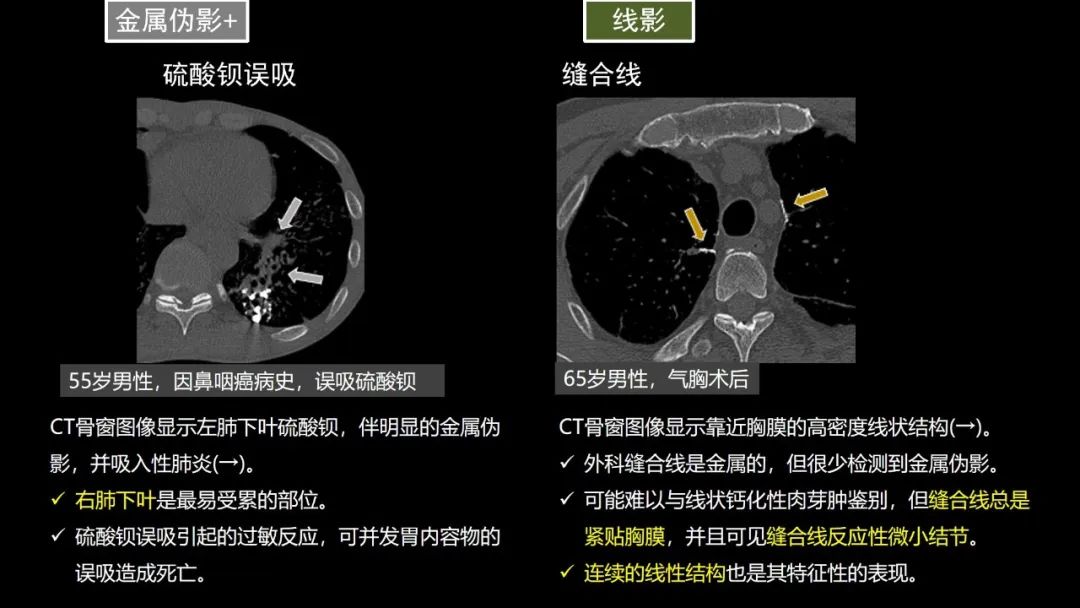 【PPT】肺部CT高密度病变诊断思路-26