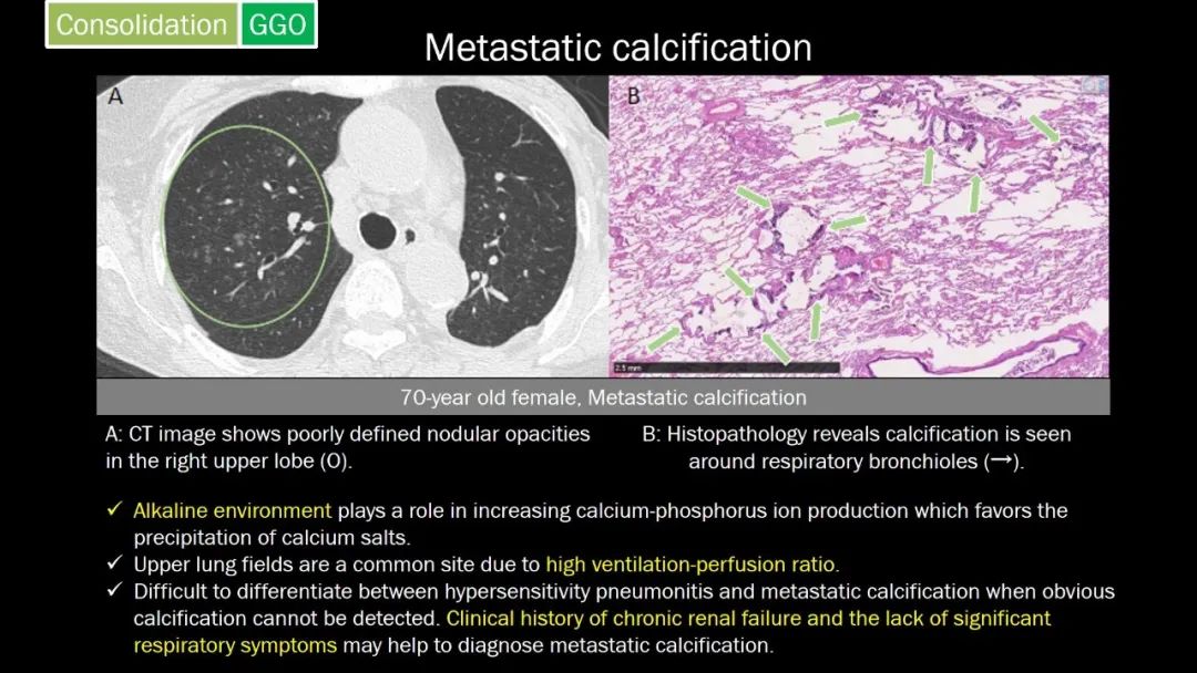 【PPT】肺部CT高密度病变诊断思路-41