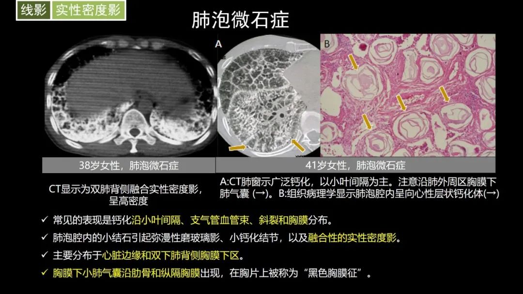 【PPT】肺部CT高密度病变诊断思路-34