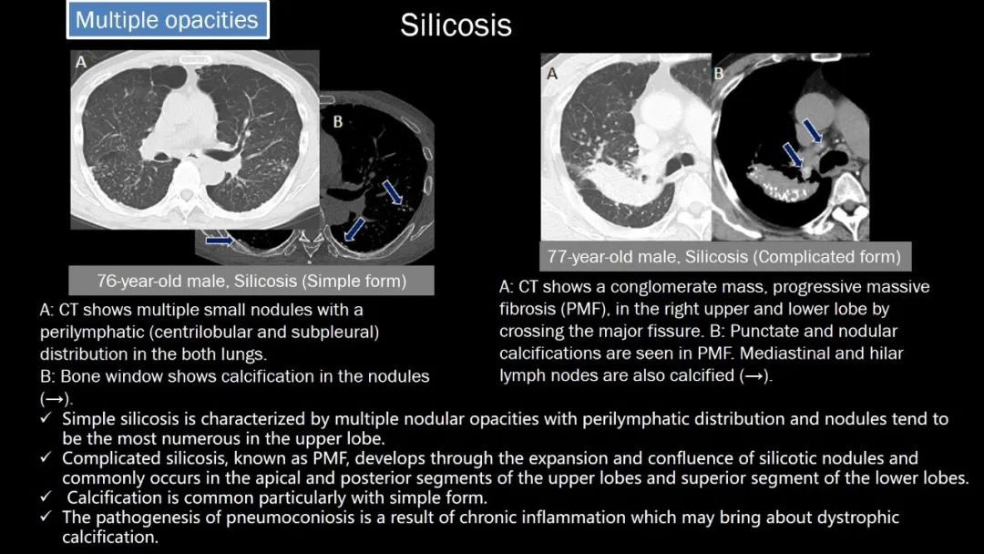 【PPT】肺部CT高密度病变诊断思路-57