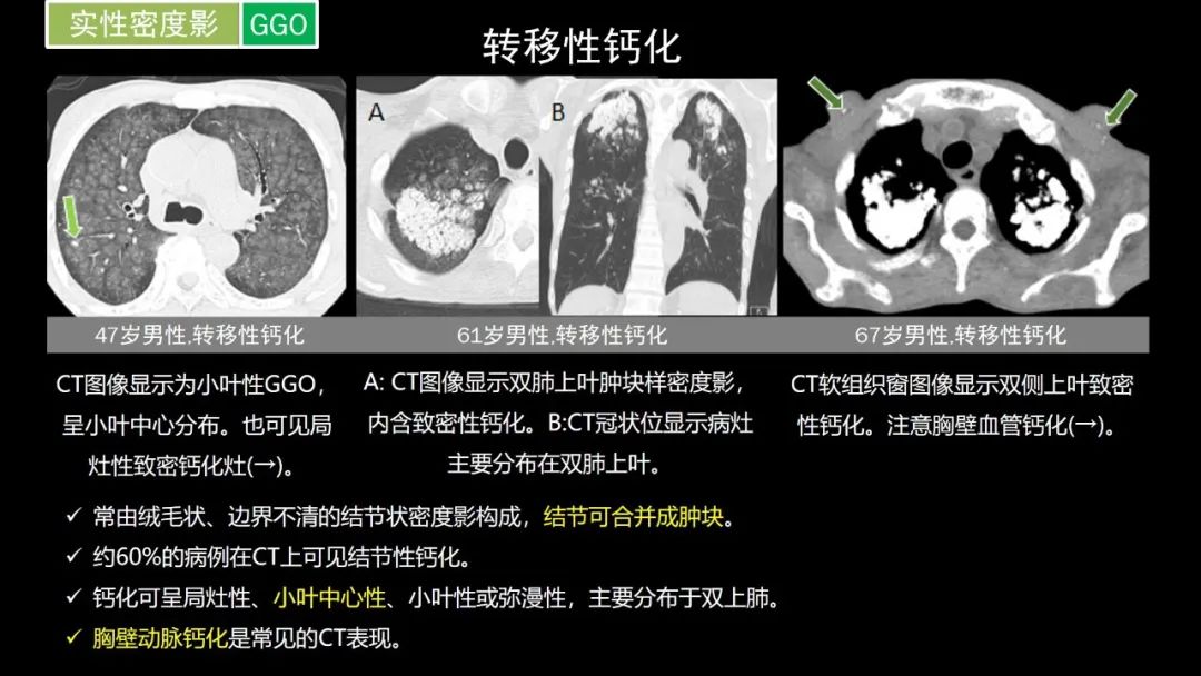 【PPT】肺部CT高密度病变诊断思路-40