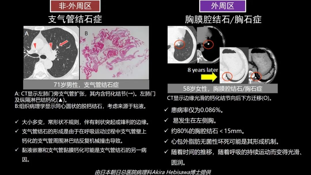 【PPT】肺部CT高密度病变诊断思路-66
