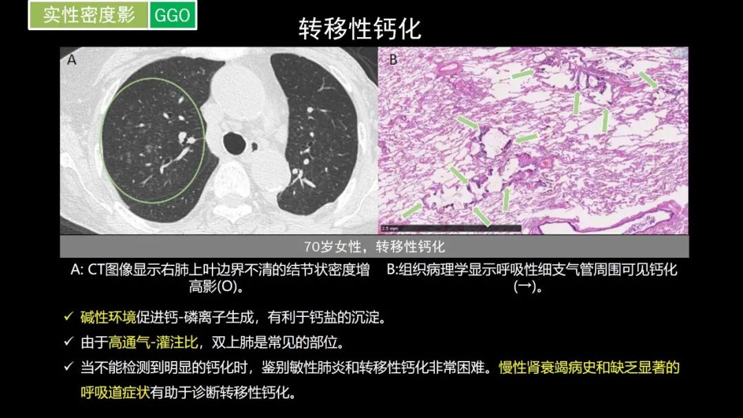 【PPT】肺部CT高密度病变诊断思路-42