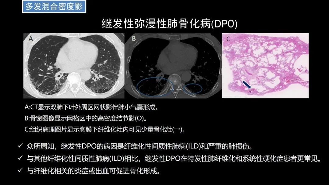 【PPT】肺部CT高密度病变诊断思路-60