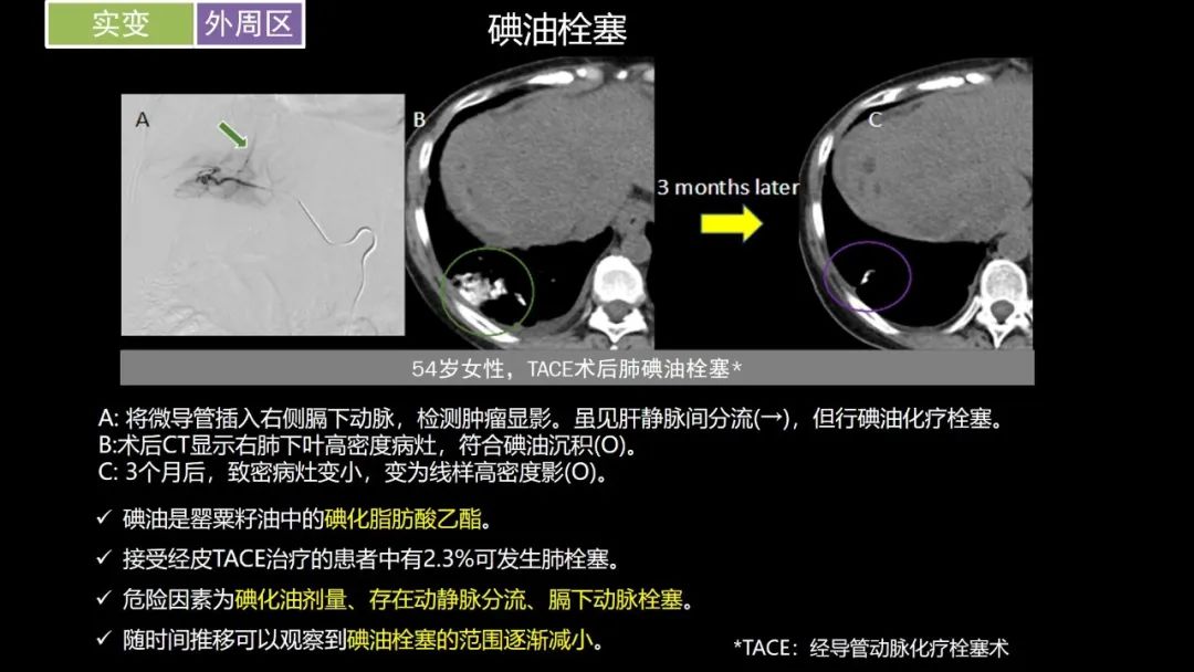 【PPT】肺部CT高密度病变诊断思路-38