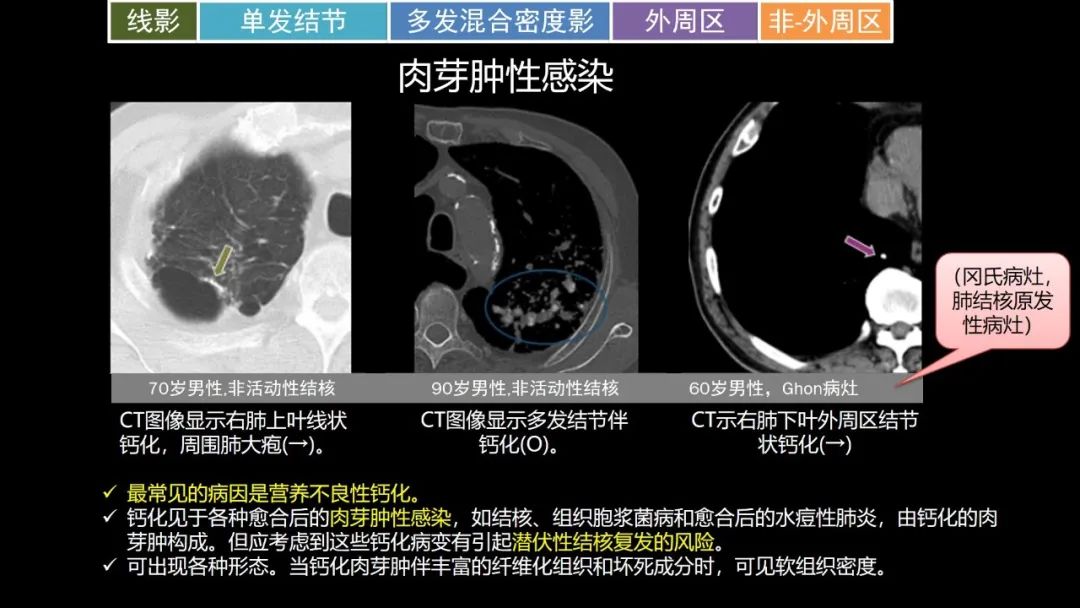 【PPT】肺部CT高密度病变诊断思路-52