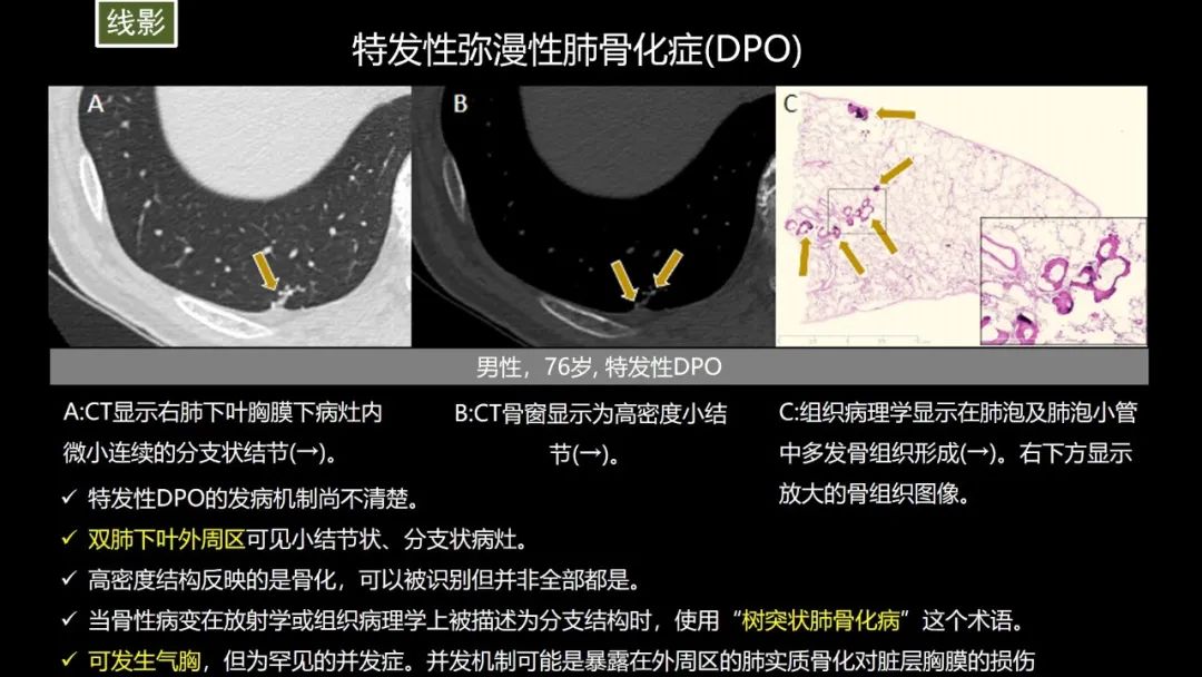 【PPT】肺部CT高密度病变诊断思路-30