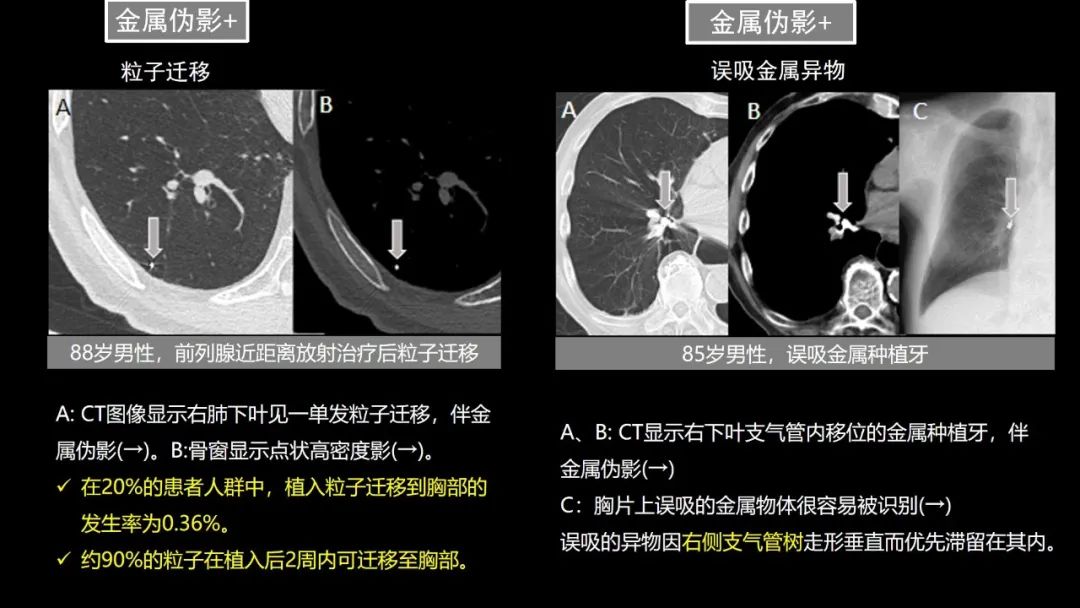 【PPT】肺部CT高密度病变诊断思路-24