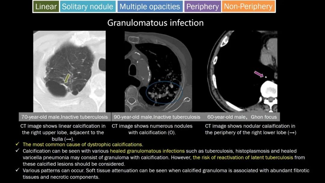【PPT】肺部CT高密度病变诊断思路-51
