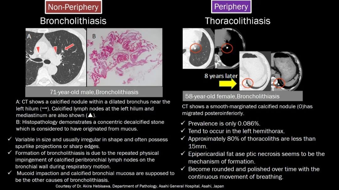 【PPT】肺部CT高密度病变诊断思路-65