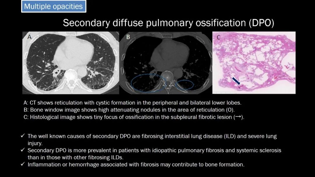 【PPT】肺部CT高密度病变诊断思路-59