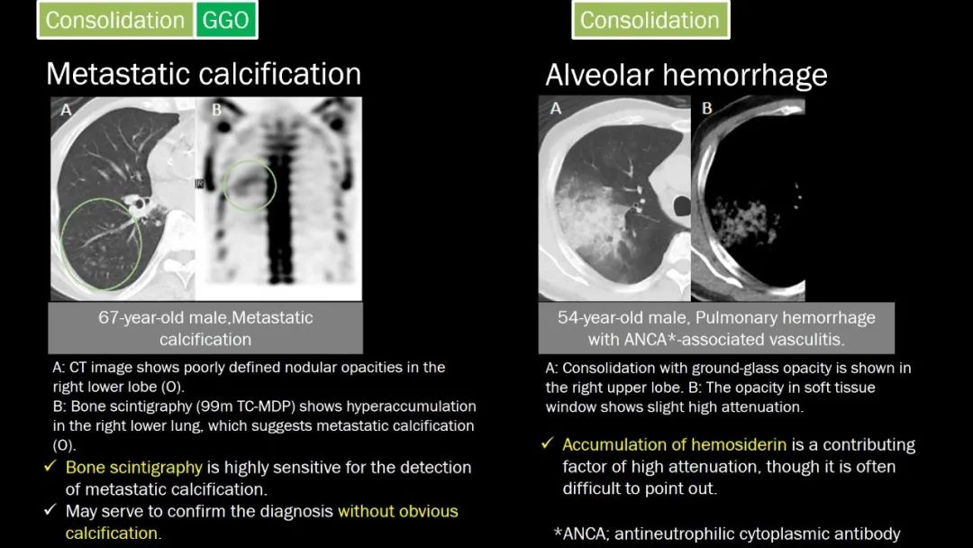 【PPT】肺部CT高密度病变诊断思路-43