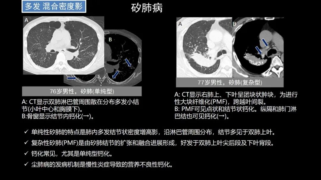 【PPT】肺部CT高密度病变诊断思路-58
