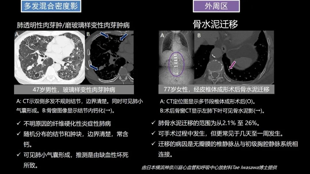 【PPT】肺部CT高密度病变诊断思路-64