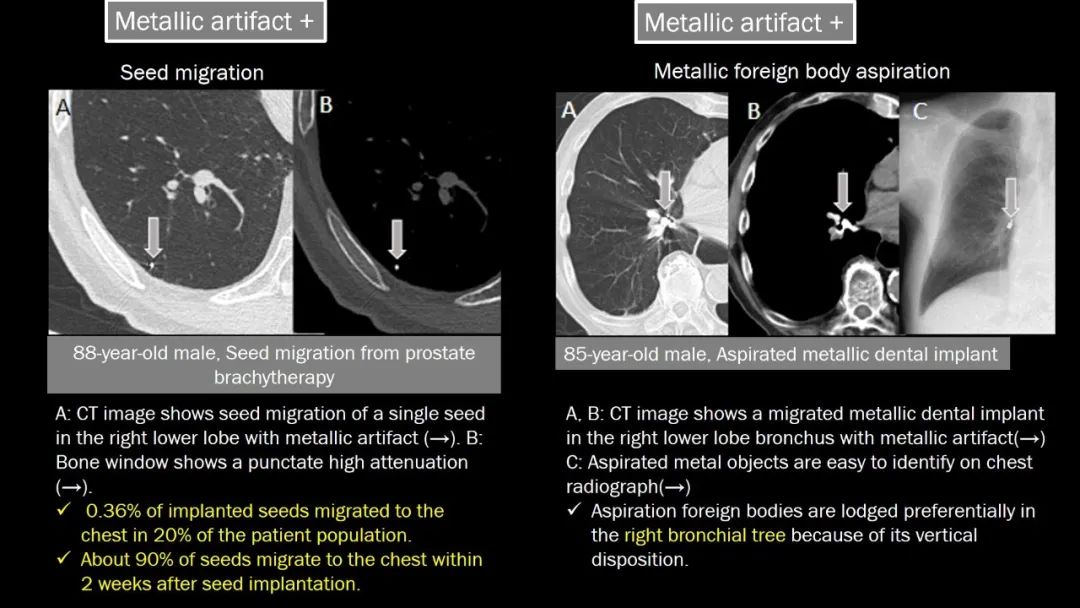 【PPT】肺部CT高密度病变诊断思路-23