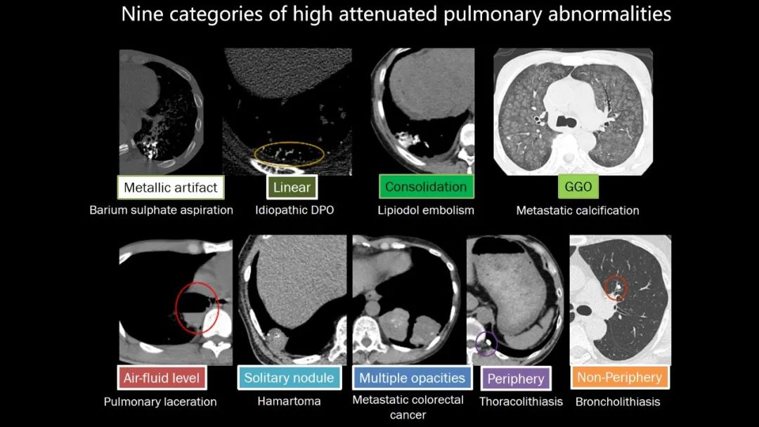 【PPT】肺部CT高密度病变诊断思路-19
