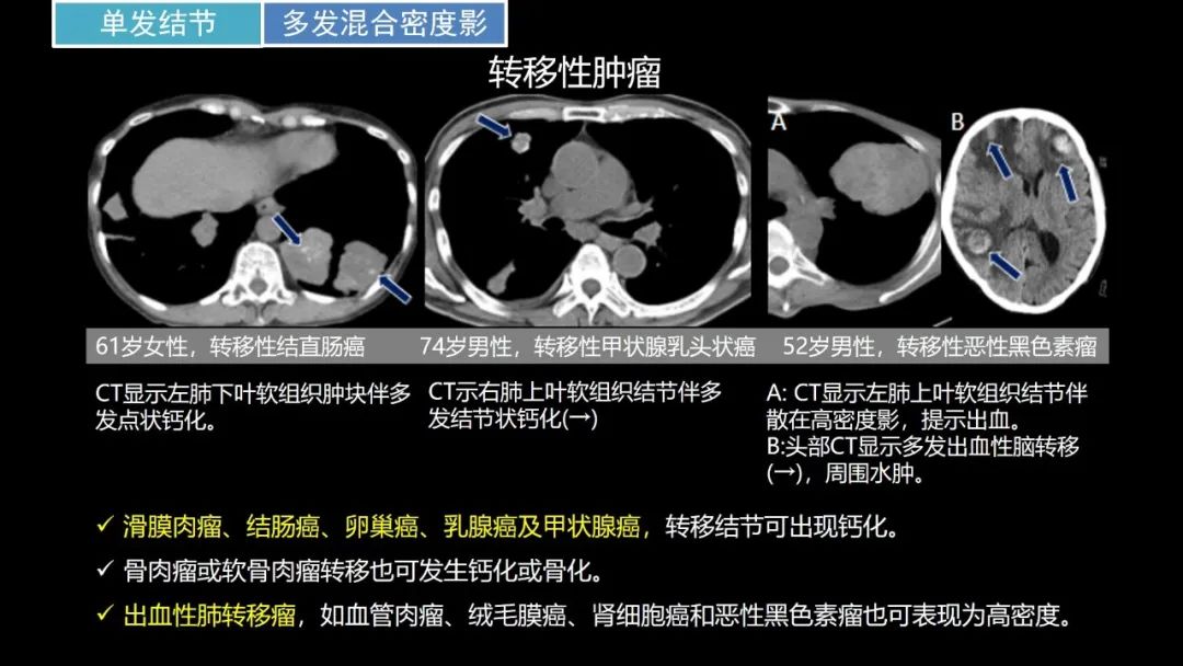 【PPT】肺部CT高密度病变诊断思路-54