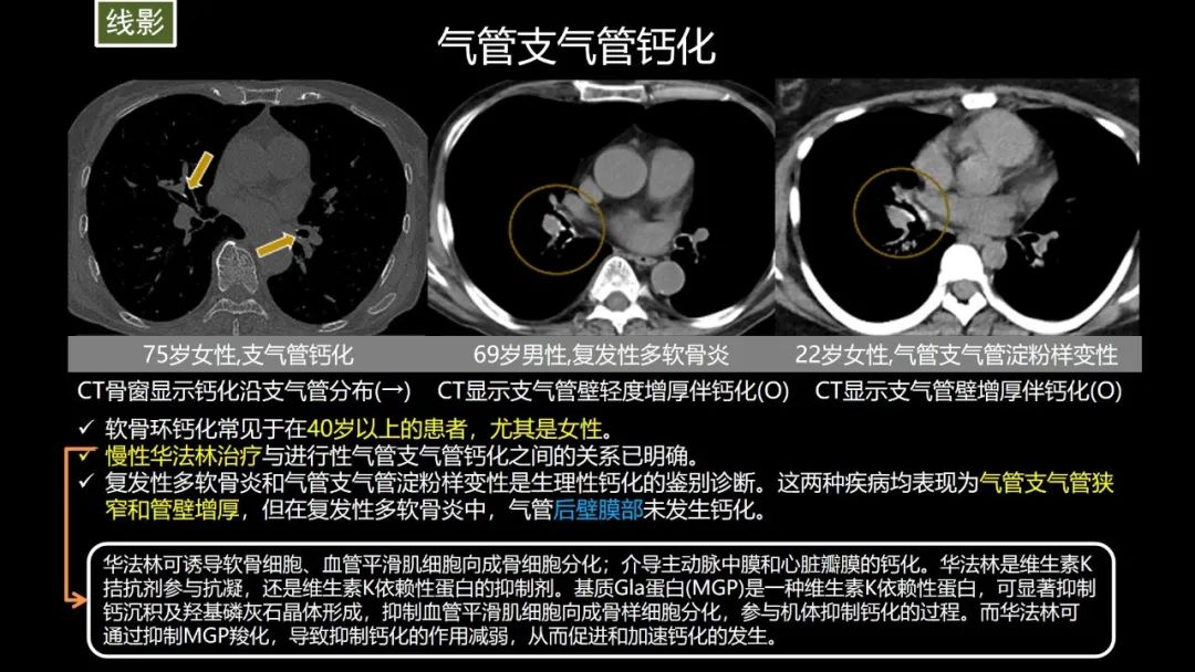 【PPT】肺部CT高密度病变诊断思路-32