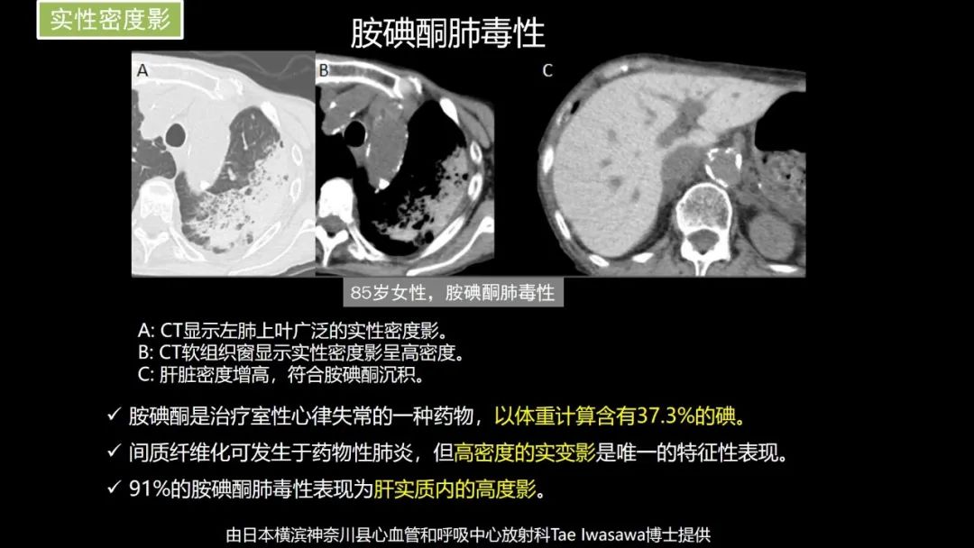 【PPT】肺部CT高密度病变诊断思路-36