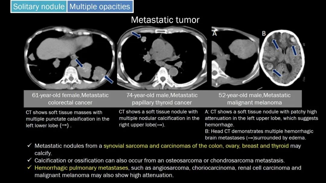 【PPT】肺部CT高密度病变诊断思路-53