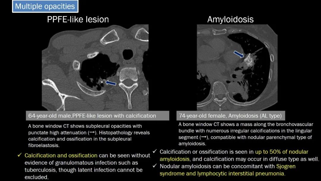 【PPT】肺部CT高密度病变诊断思路-55