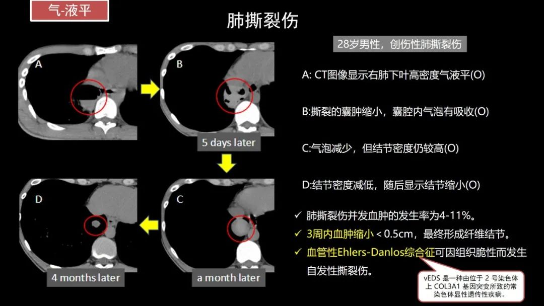 【PPT】肺部CT高密度病变诊断思路-46
