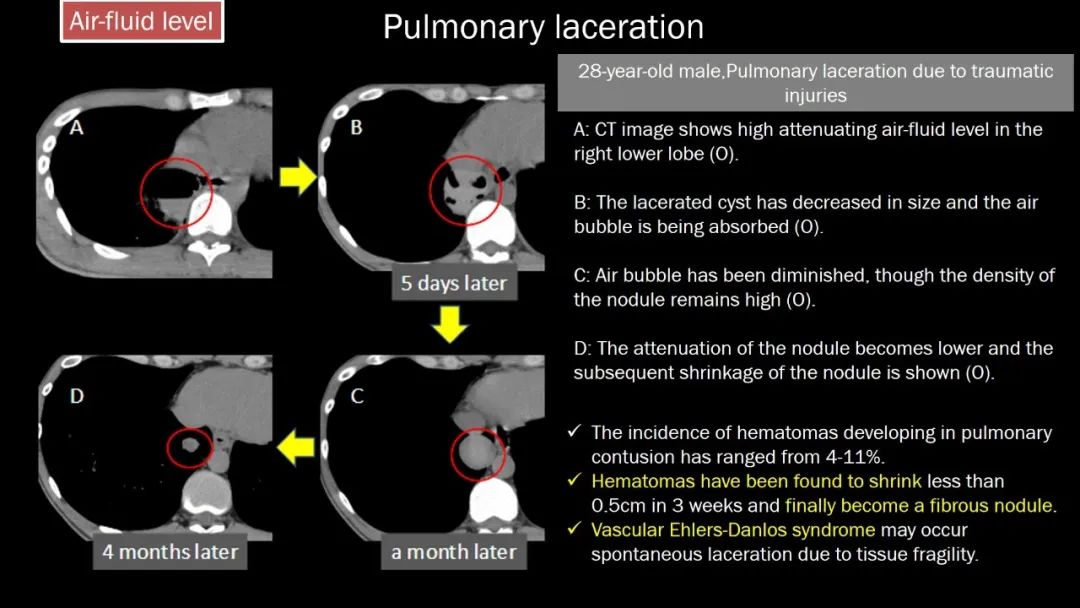 【PPT】肺部CT高密度病变诊断思路-45