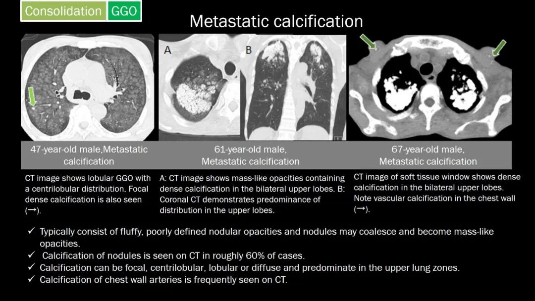 【PPT】肺部CT高密度病变诊断思路-39