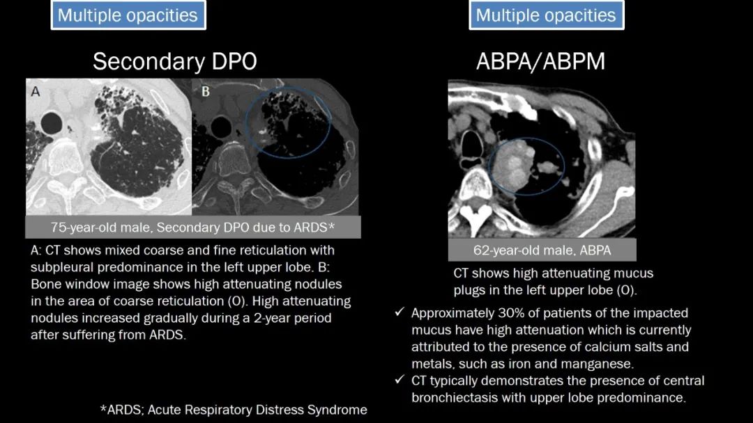 【PPT】肺部CT高密度病变诊断思路-61
