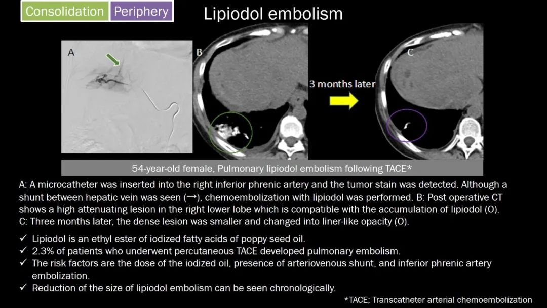 【PPT】肺部CT高密度病变诊断思路-37
