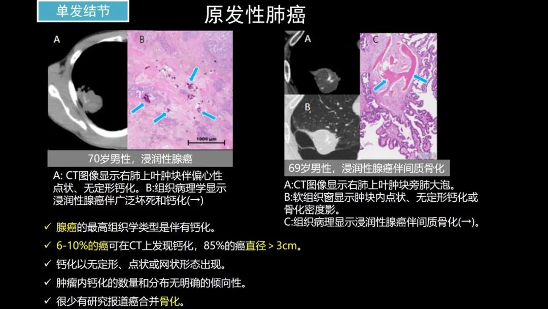 【PPT】肺部CT高密度病变诊断思路-48