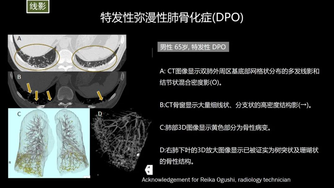 【PPT】肺部CT高密度病变诊断思路-28