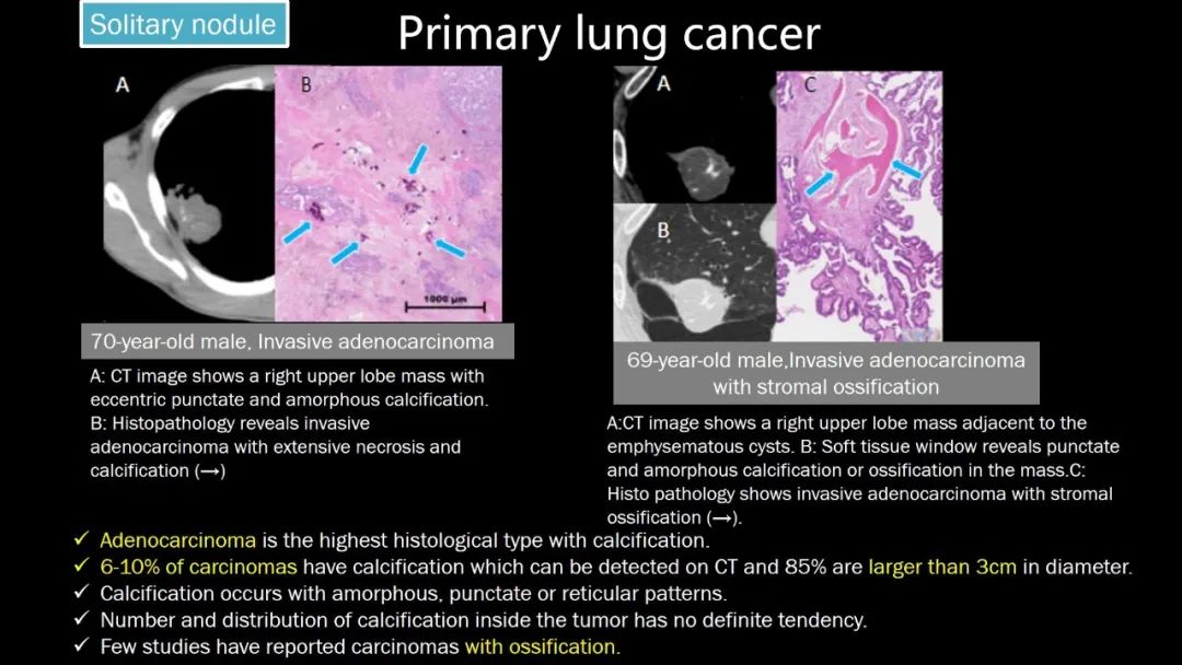 【PPT】肺部CT高密度病变诊断思路-47