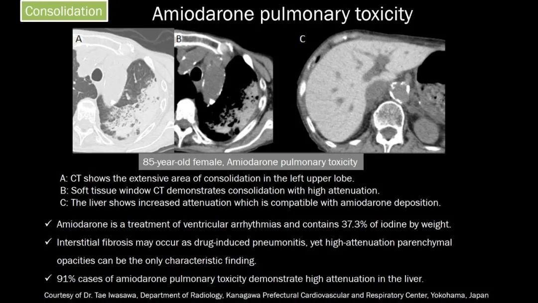 【PPT】肺部CT高密度病变诊断思路-35