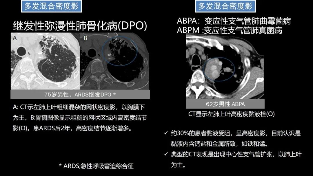 【PPT】肺部CT高密度病变诊断思路-62