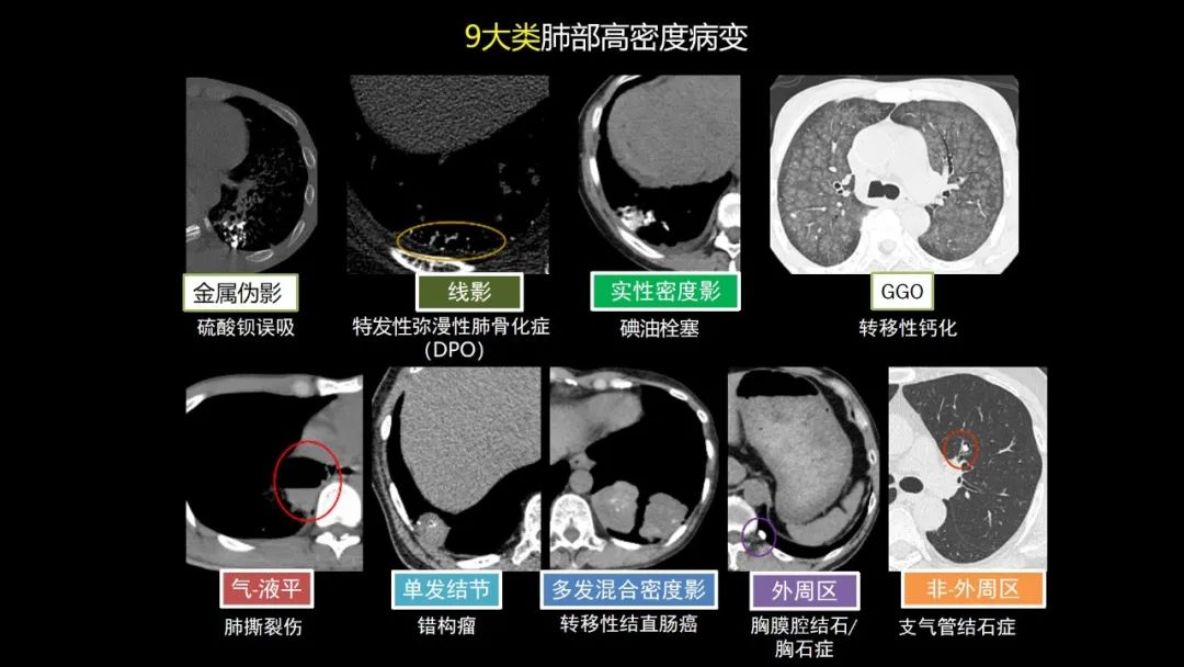 【PPT】肺部CT高密度病变诊断思路-20