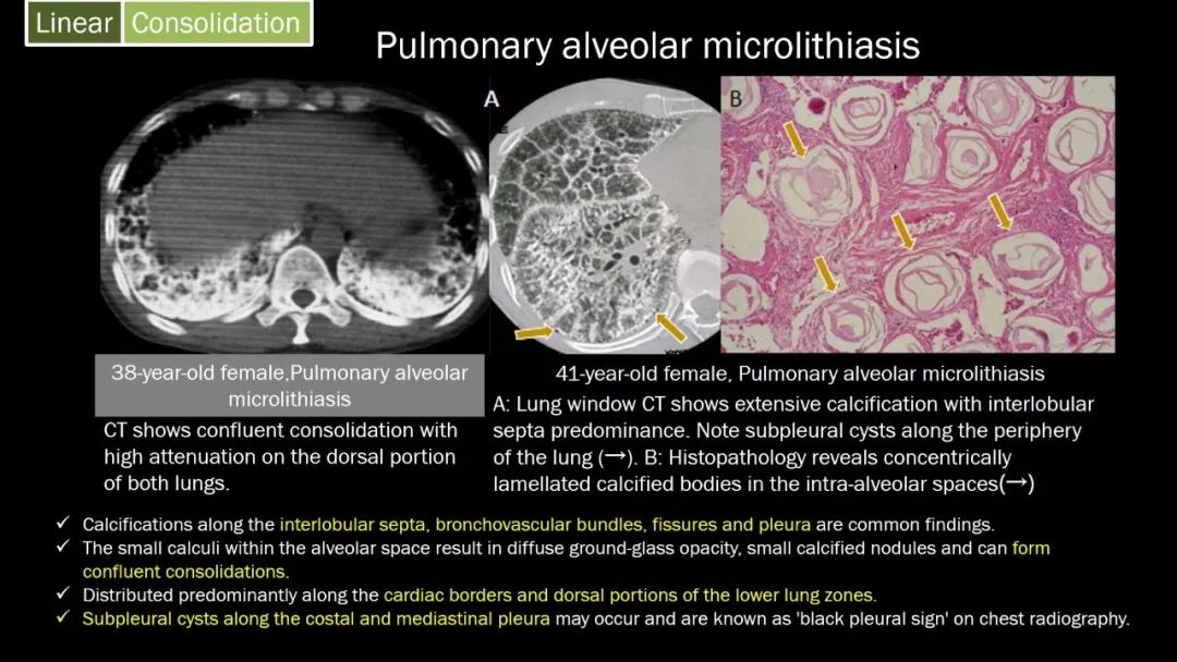 【PPT】肺部CT高密度病变诊断思路-33