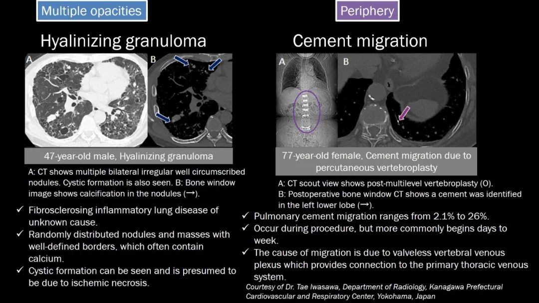 【PPT】肺部CT高密度病变诊断思路-63