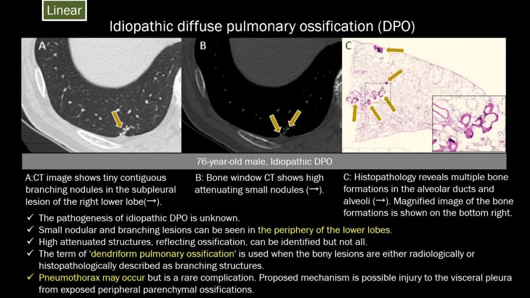 【PPT】肺部CT高密度病变诊断思路-29