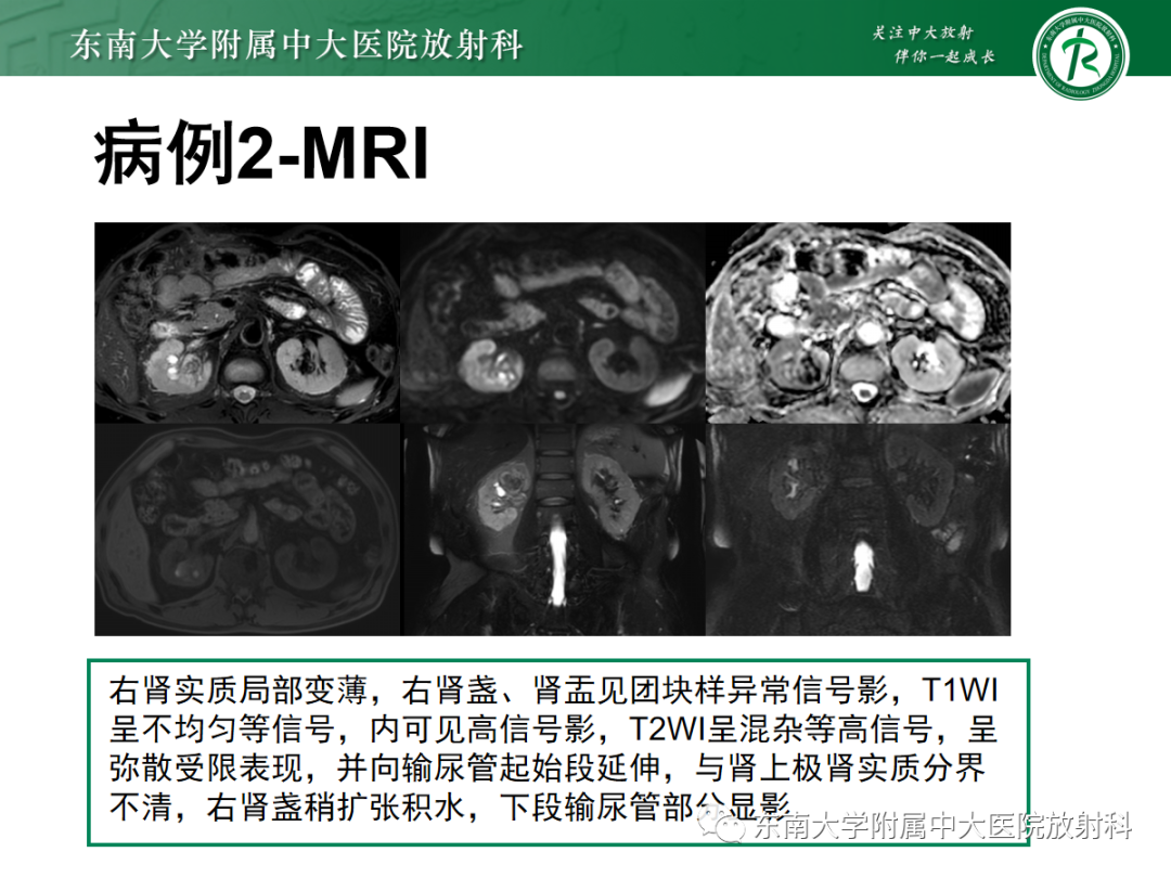 【PPT】肾盂癌-15
