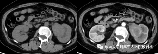 【PPT】肾盂癌-1